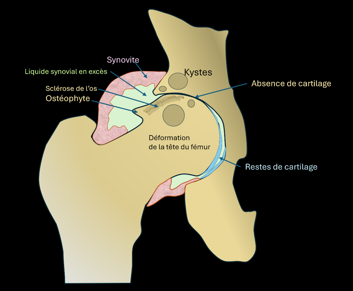 représentation schématique d’une hanche avec de l’arthrose (coxarthrose)